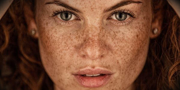 Face hyperpigmentation