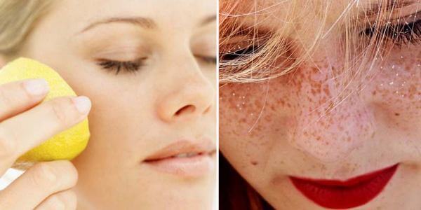 How to get rid of freckles