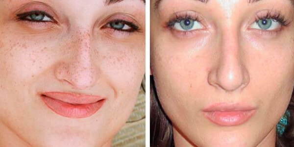 Before and after removing freckles