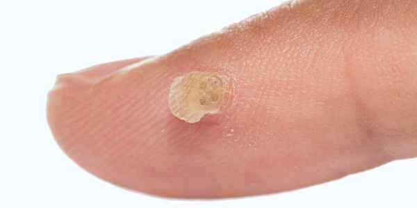 Wart on finger