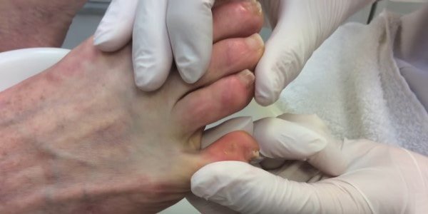 Wart on foot