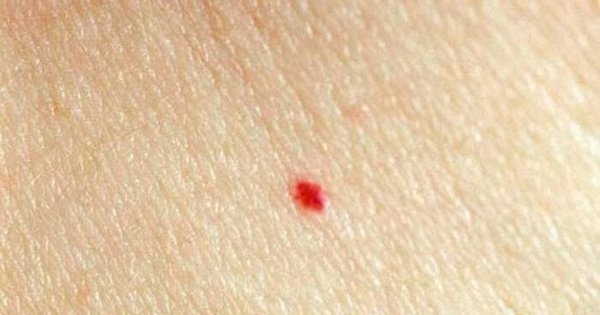 Red mole on the body