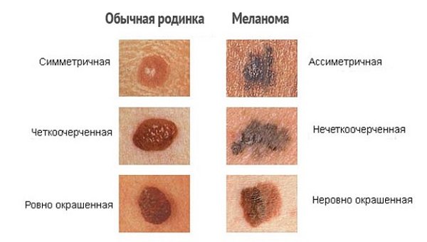 The difference between melanoma and the usual mole