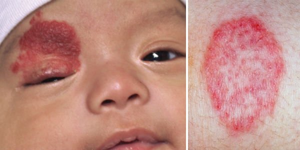 Hemangioma in a child