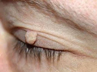 Xanthelasma