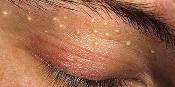 Xanthelasma century