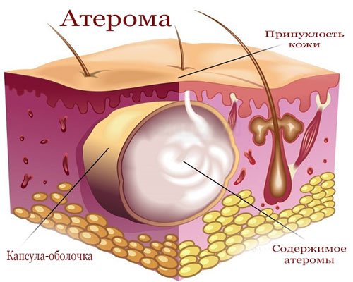 Atheroma