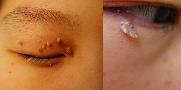 Atheroma on the eyelid