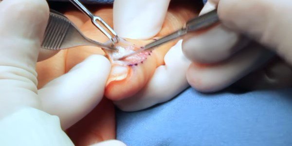 Removal of atheroma surgically