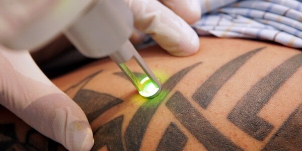 Tattoo removal