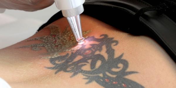 Laser tattoo removal