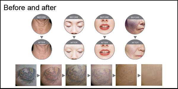 Before and after tattoo removal