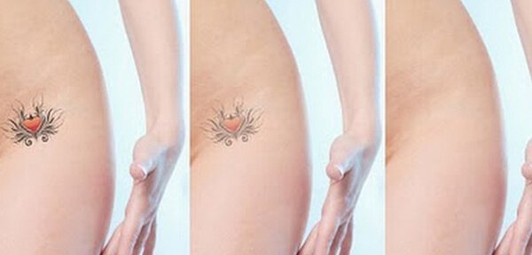 Tattoo removal