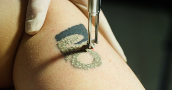 Laser tattoo removal