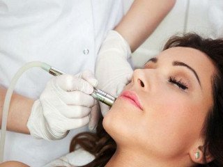 Laser removal of facial vessels