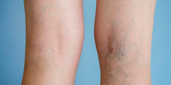 Varicose veins