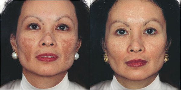 Before and after removing pigment spots on the face