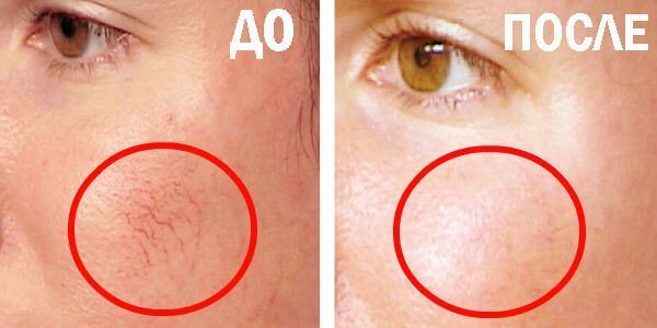 Before and after treatment of rosacea