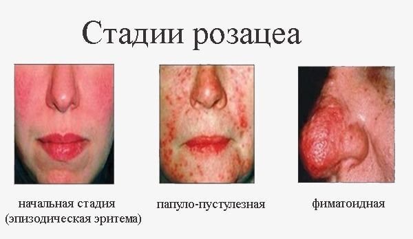 Stages of rosacea