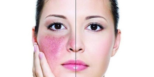 Rosacea in a woman