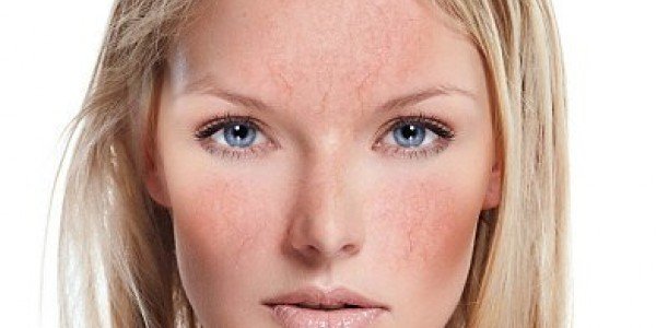 Rosacea