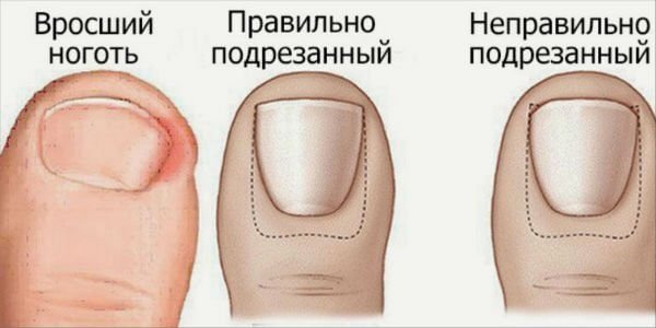 Prevention of ingrown toenails