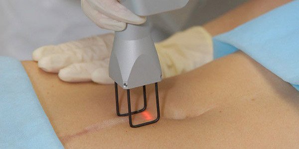 Laser scar removal