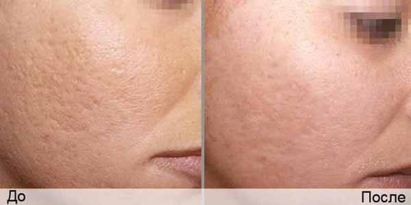 Before and after laser resurfacing