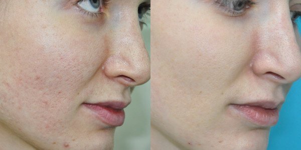 Laser polishing face: before and after