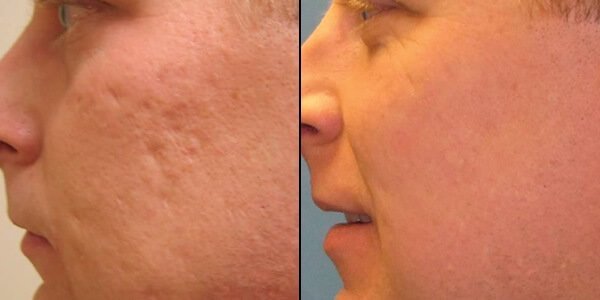 Before and after laser resurfacing of the face