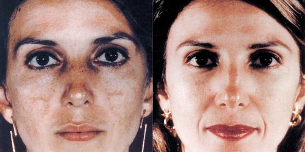 Before and after the removal of age spots from the face