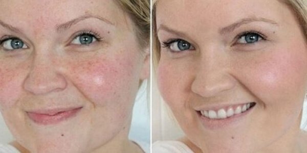 Laser face cleaning: before and after