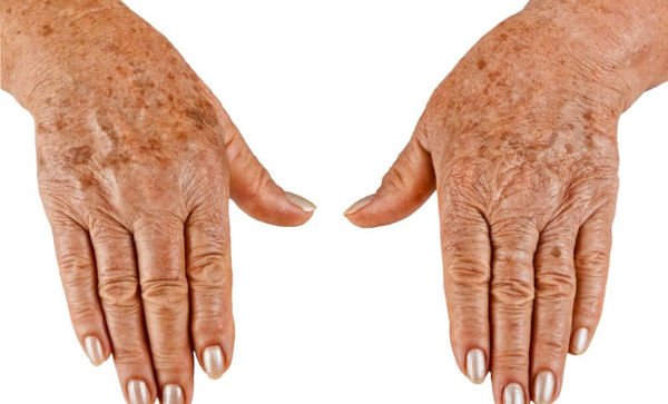 Pigment spots on the hands