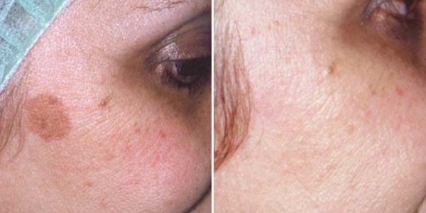 Removal of age spots: photo before and after