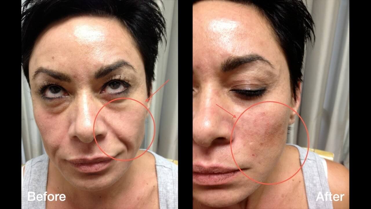 The process of facial rejuvenation fillers