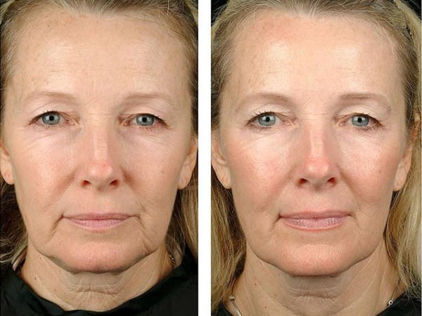 Facelift results