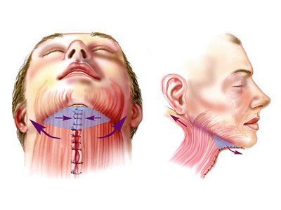 Features of face skin lifting on the neck