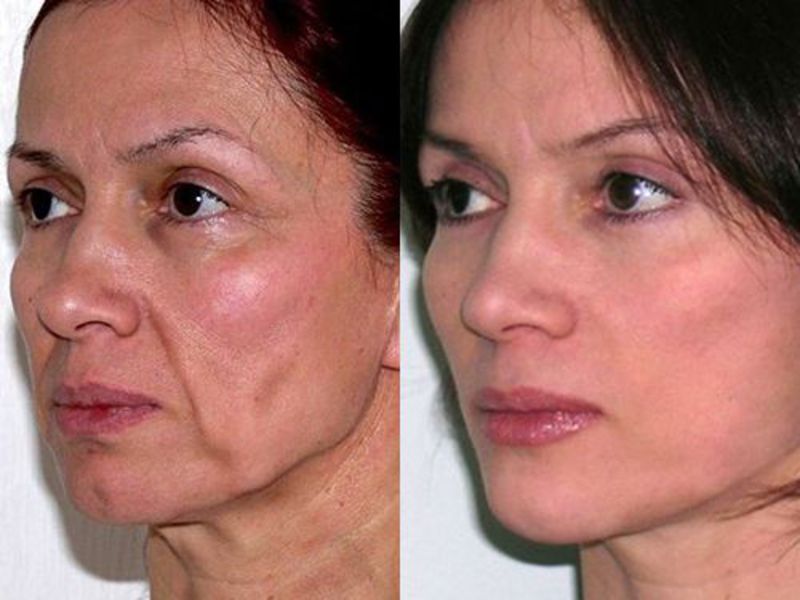 Facelift with SMAS technology