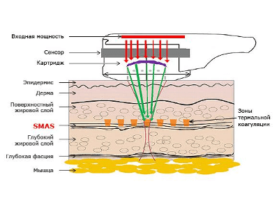 Features ultrasonic braces