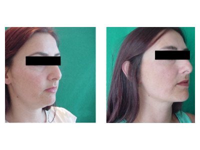 Change after cheek correction