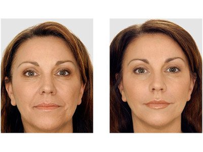 The results of the contour of the nasolabial folds