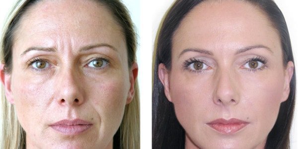 Skin rejuvenation