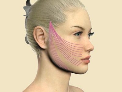 4D threads for facelift