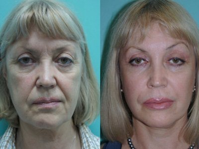 The result of injectable facelift