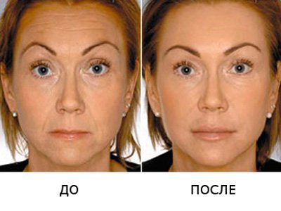 Facial contour correction with hyaluronic acid