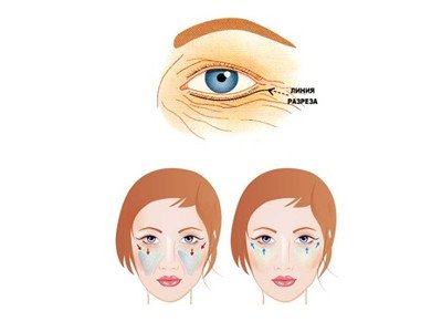 Endoscopic rejuvenation of the midface