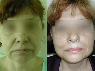 Lower face lift: results