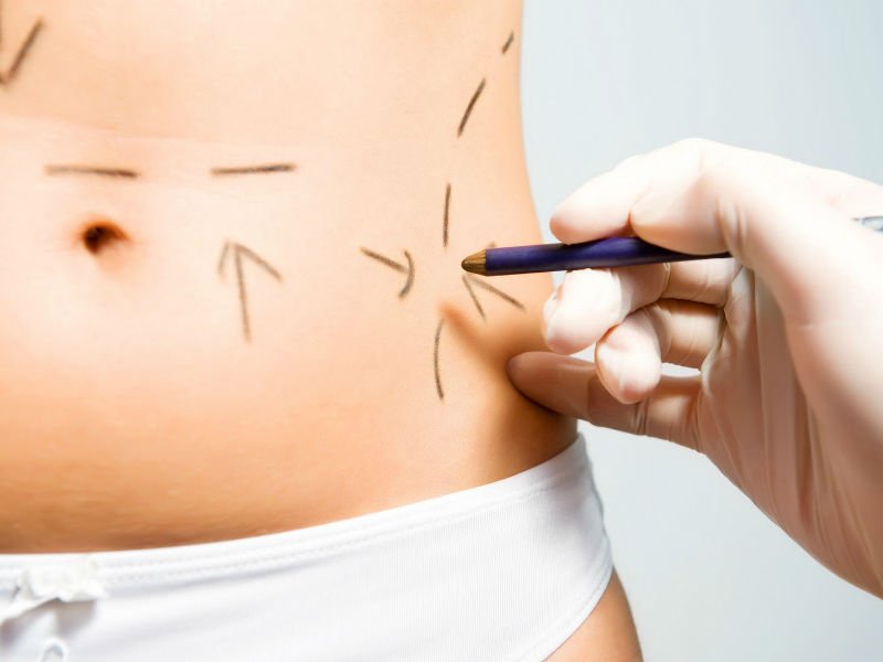 The patient is offered different types of abdominal liposuction.