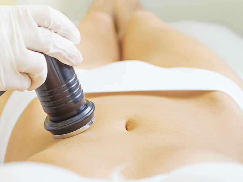 Ultrasound liposuction of the abdomen