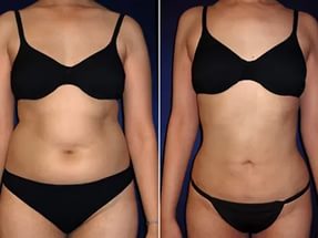 Liposuction of abdominal fat: before and after